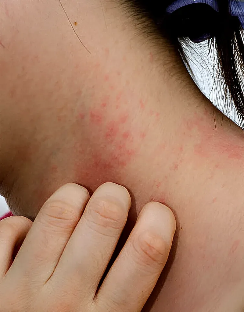 Red skin irritation